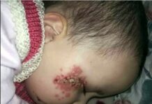 Impetigo Spanien
