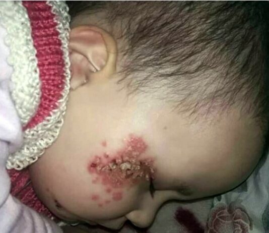 Impetigo Spanien