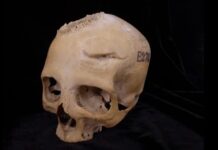 Zwei Spanische Wissenschaftler entdecken die erste Krebsoperation der Geschichte