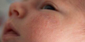 Warnung in Spanien aufgrund der Zunahme der Fälle des Slap-Virus